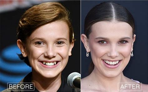 millie bobby brown teeth|millie bobby brown teeth pictures.